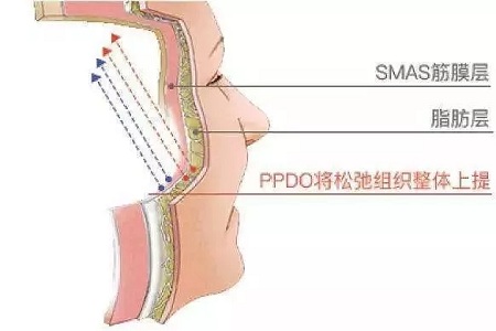 面部线雕有哪些好处