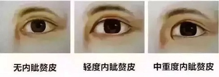 双眼皮开眼角