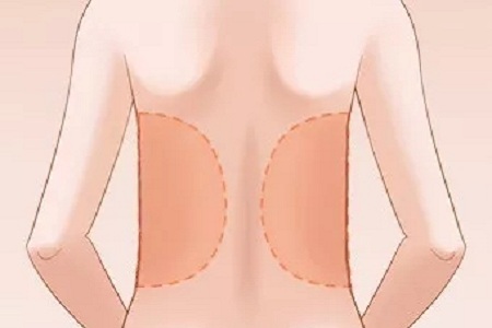成都做腰部吸脂手术会有疤痕吗