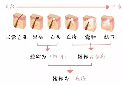 痤疮的分类