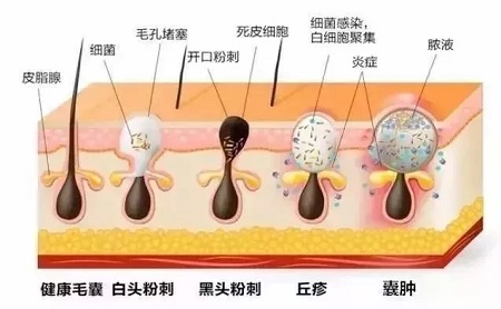 痤疮的形成和演变