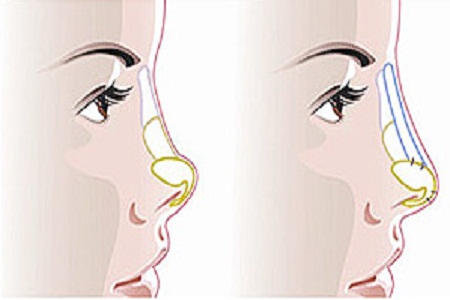 假体隆鼻出现排异有哪些症状