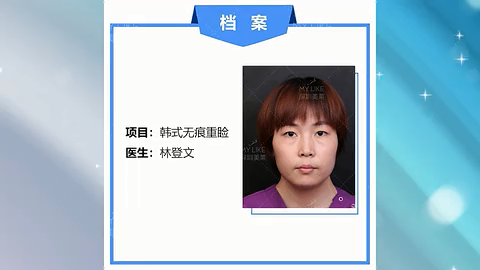 深圳美莱林登文医师的双眼皮案例