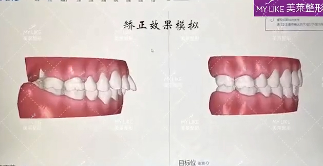 天津美莱口腔·专业口扫 预见矫正效果