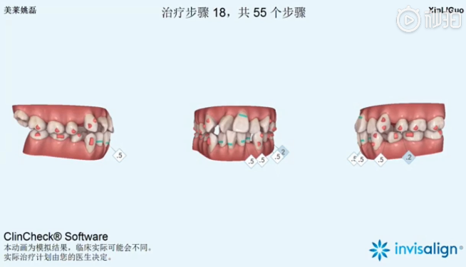 南京美莱口腔全景侧位片，拍照取模，动画方案设计