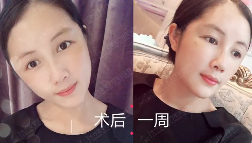 长沙美莱面部脂肪填充案例