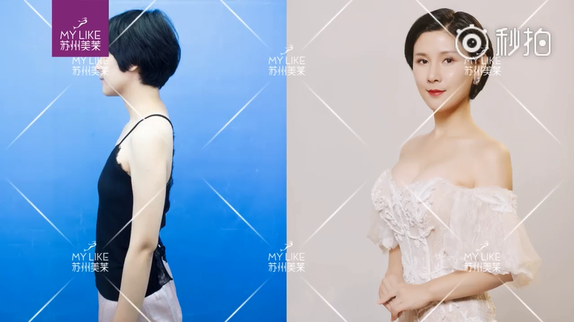 苏州美莱胸部整形案例