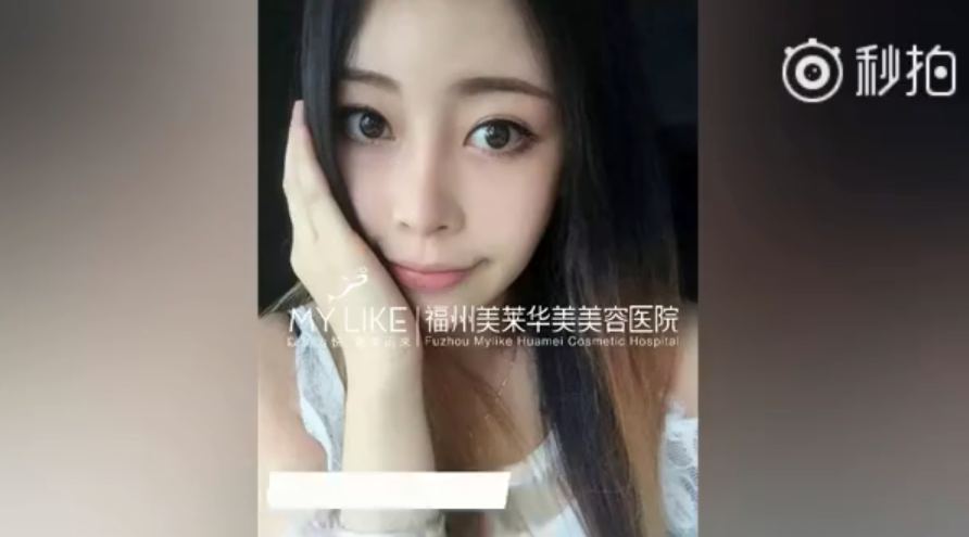 福州美莱鼻子几毫米的改变，自信百倍的蜕变