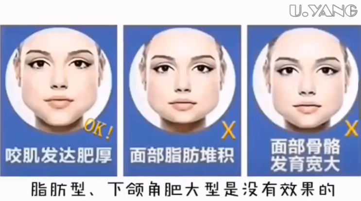 南京美莱瘦脸全过程图