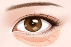 郑州美莱祛眼袋手术注意事项有哪些？