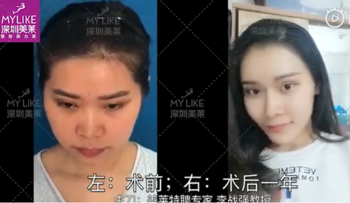 深圳美莱面部整形前后效果对比图