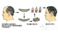 郑州美莱整形医院植发做的好吗