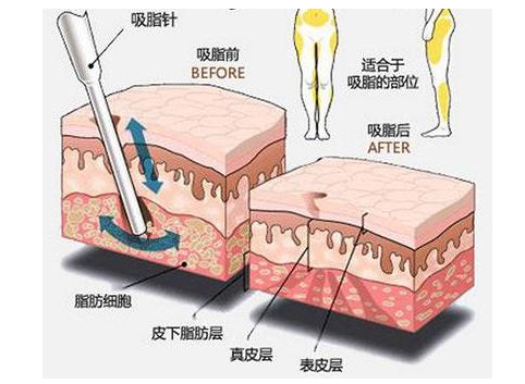 郑州美莱吸脂瘦身等于减重？