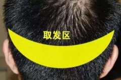 郑州美莱头发种植之术后常见问题（四）
