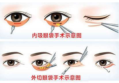 深圳美莱祛除眼袋的最好办法是什么？