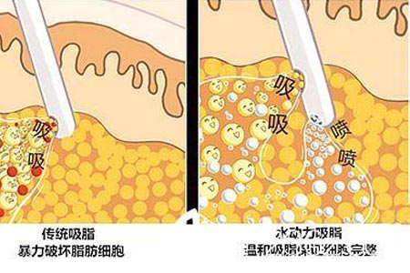 腹部吸脂减肥会反弹吗