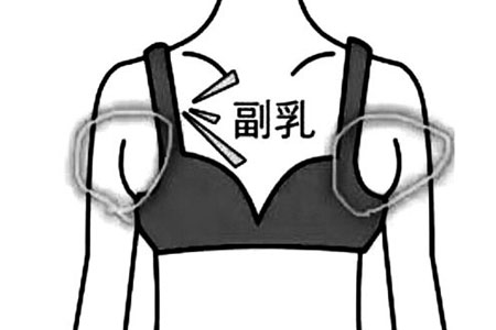 副乳切除术后需要住院吗