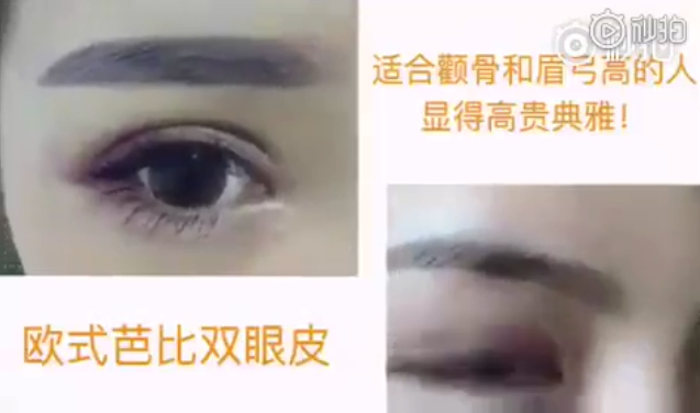 武汉美莱欧式双眼皮，虽然好看但不是每个人都适合的