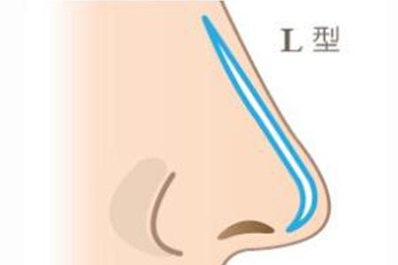 在广州做假体隆鼻手术大概价格多少