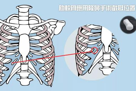 深圳隆鼻医院做软骨隆鼻多少钱