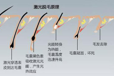 冰点脱毛的价格多少