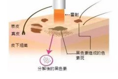 激光祛斑效果怎么样,会反弹吗