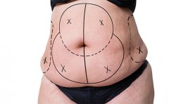 腰腹吸脂对身体有害吗，腰腹环吸抽脂需要多久恢复期