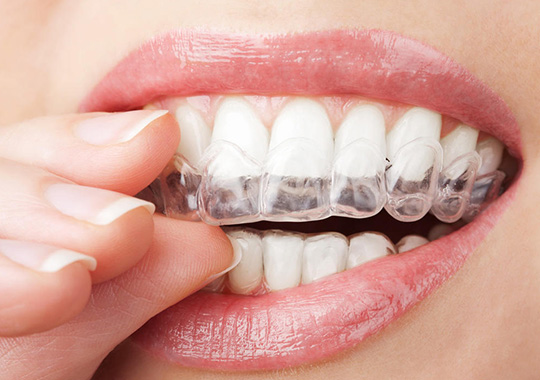 成都牙齿矫正哪家口腔医院比较好，矫正牙齿一般要花多少时间
