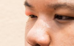 天生肿眼泡抽脂会反弹吗，南京、杭州、上海眼皮抽脂费用表