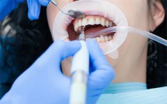 冷光美白牙齿一次可以维持多久，特点、优势以及术后护理揭晓