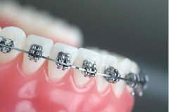 金属自锁托槽牙齿矫正价格，多久能看见效果