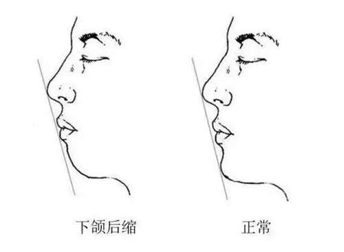 怎样判断下巴是否短缩